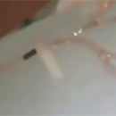 Microscopic Soft Robots Revolutionizing Minimally Invasive Surgery